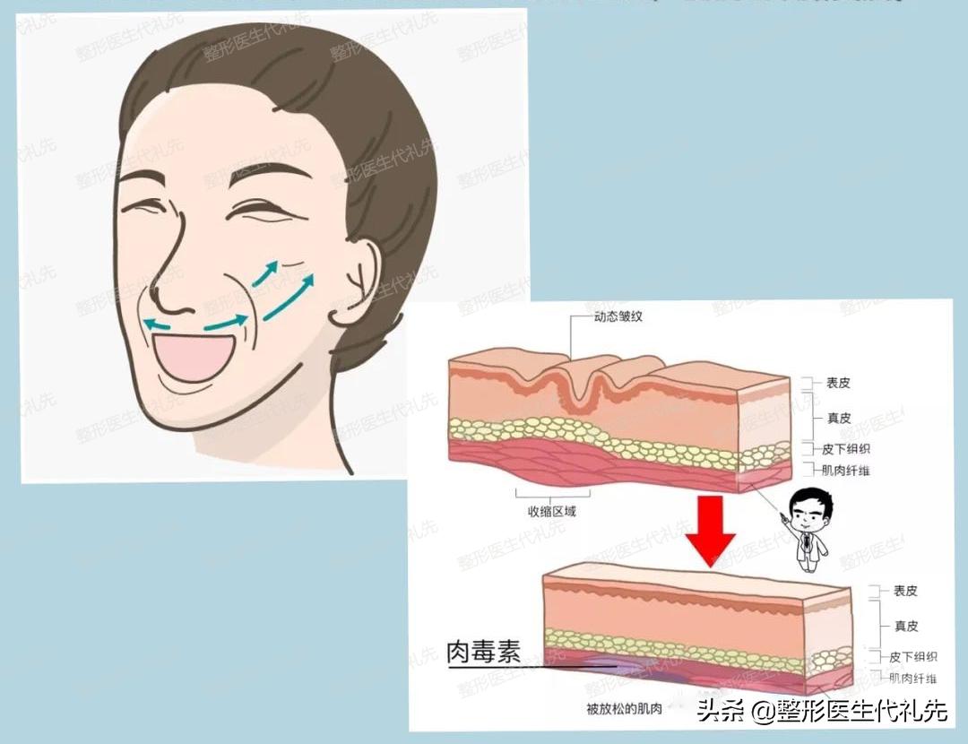 从整形医生的角度来聊一聊形成法令纹的原因以及改善方案