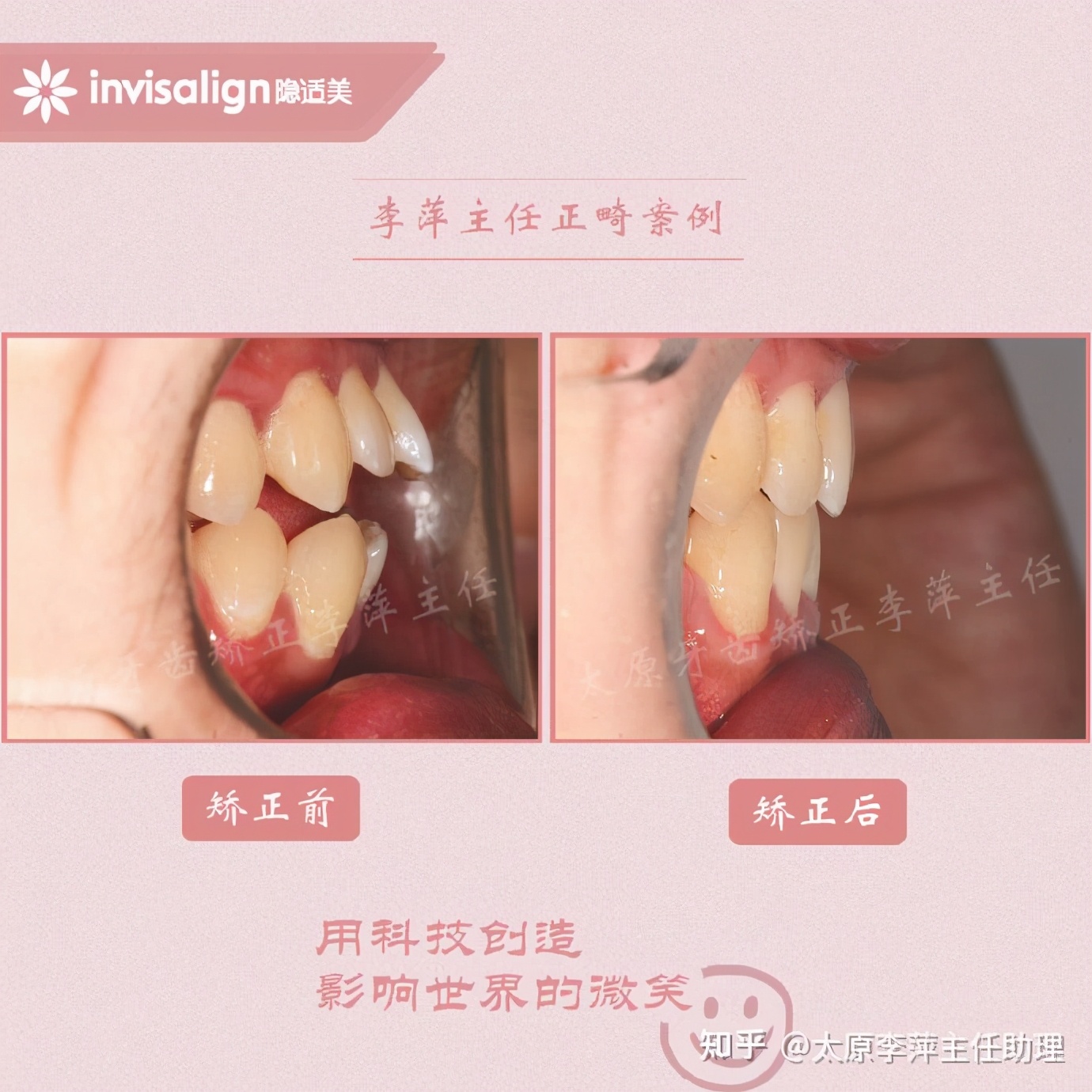 太原矫正牙齿需要做正颌吗,太原牙齿二次矫正