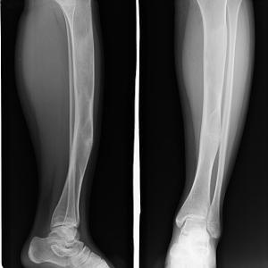 儿童骨纤维结构不良图片,8岁儿童骨纤维结构不良