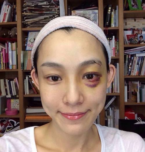 范玮琪下巴缝15针照片,范玮琪晒素颜照皮肤焦黄显憔悴