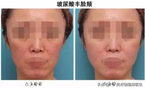 为什么注射玻尿酸会淤青,玻尿酸僵尸脸