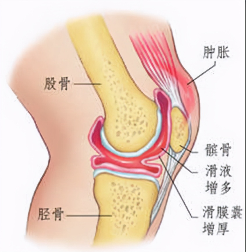 膝关节红肿发热疼痛是痛风吗,膝关节红肿发热疼痛