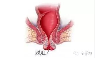 男性肛周潮湿是啥病,外痔引起的肛周潮湿