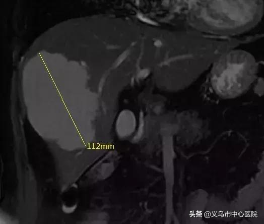 介入治疗特大血管瘤方法,微创治疗巨大肝血管瘤新突破