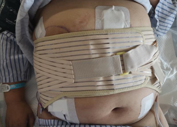 老年人腹壁切口疝用腹带效果如何,腹壁疝术后睡觉要绑腹带吗