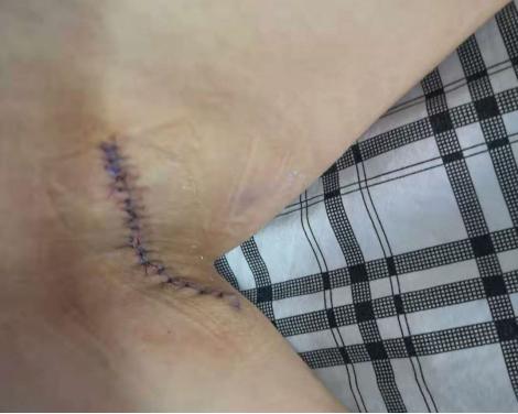 新型微波无创治疗腋臭过程,非手术微波祛狐臭