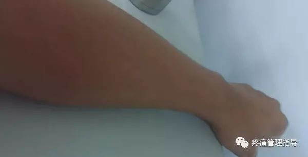 网球肘能自我恢复吗,网球肘病因的解剖学研究