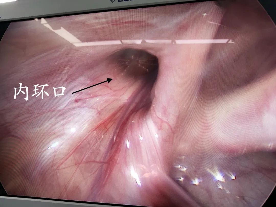 宝宝腹部有小鼓包是便便吗,小孩腹部鼓包图片