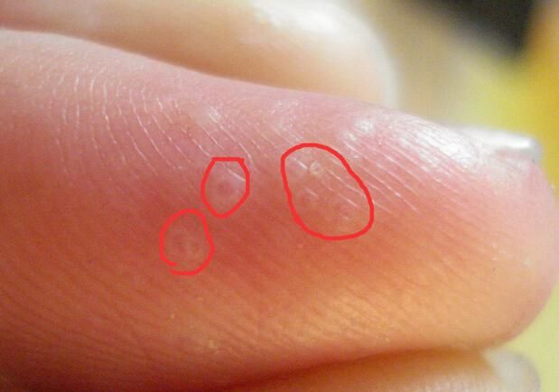 汗疱疹是不是长水泡一挠就变大,手上有小疱疹挠坏了有水