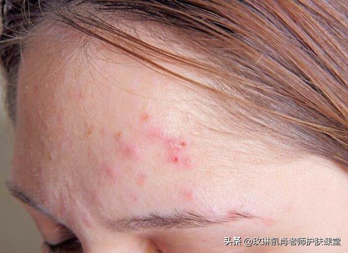 额头脸颊下巴长痘怎么调理,额头脸颊下巴反复长痘如何调理