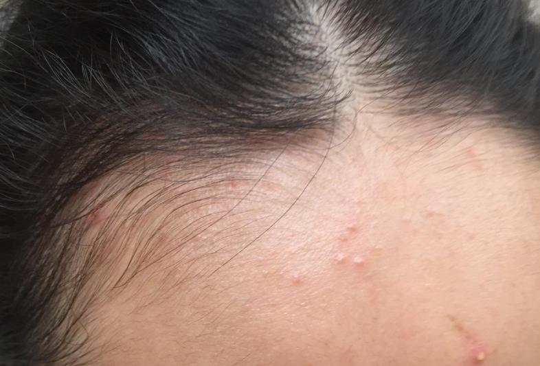 脸上长痘是身体原因还是皮肤原因,脸上长痘可能是什么病引起的