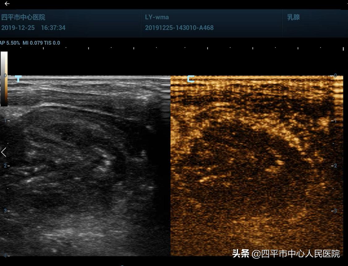 超声引导下甲状腺结节微波消融术,甲状腺结节微波消融术哪有做的