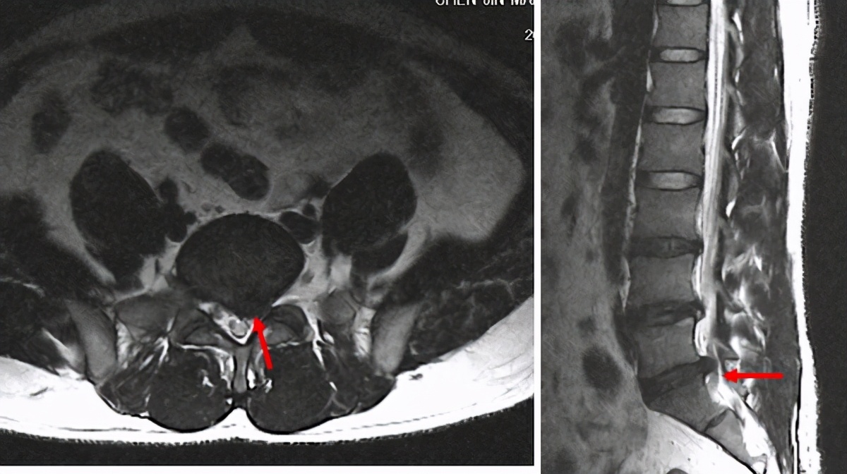 得了腰椎间盘突出症是不是人就废了,得了腰椎间盘突出症状怎么消失