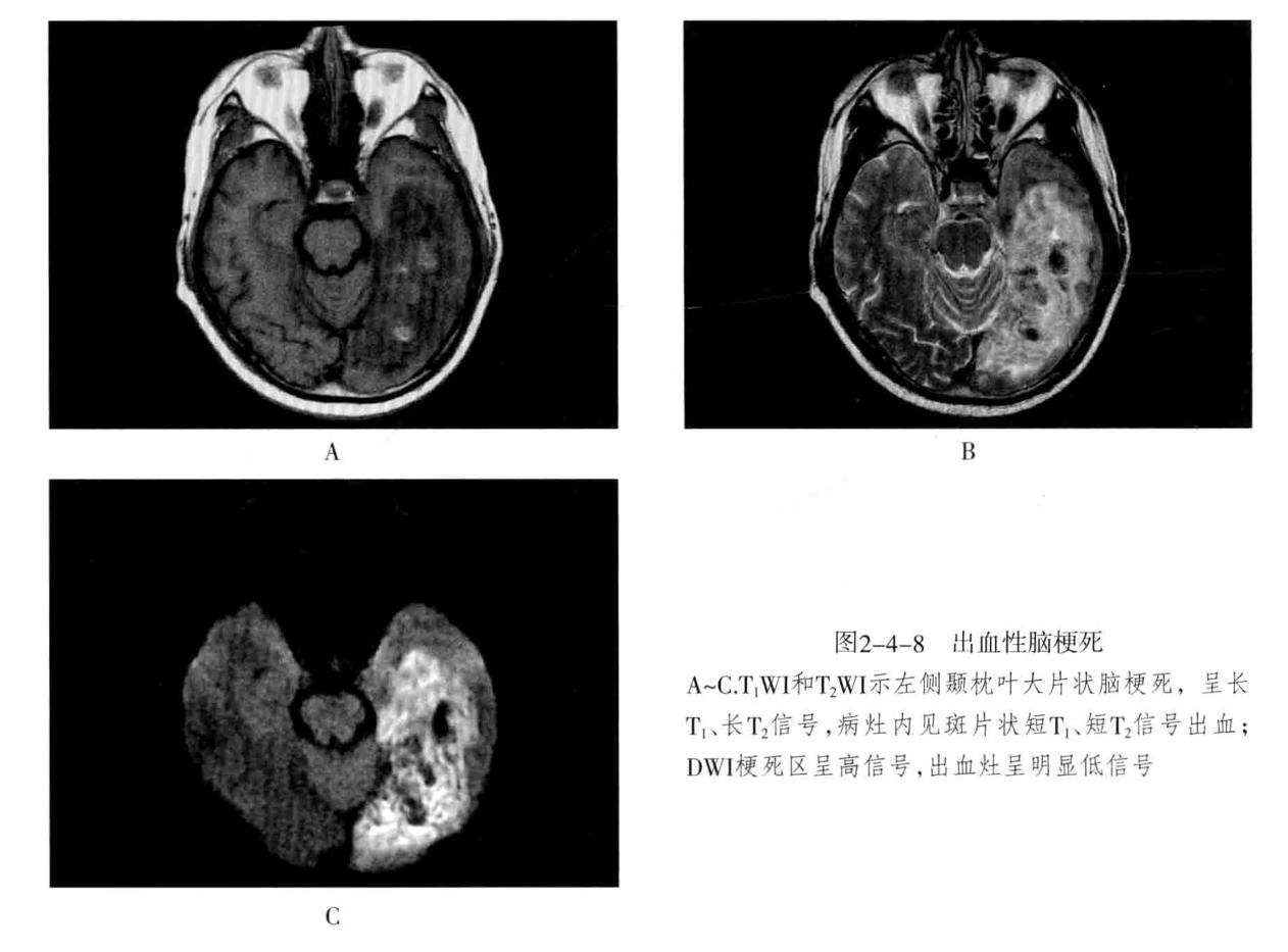 颅内血管周围间隙的影像鉴别,颅脑血管源性疾病影像诊断