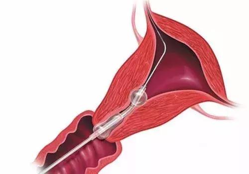 三维输卵管通液造影检查优缺点,输卵管检查和造影有什么区别