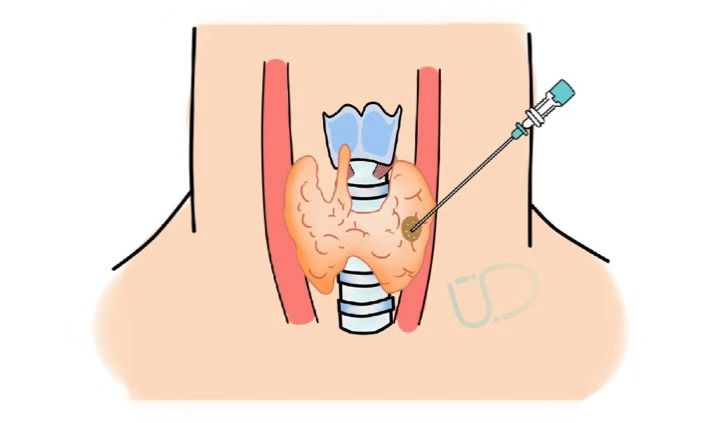 发现甲状腺结节和乳腺结节怎么办,怀孕后发现甲状腺结节4a级怎么办
