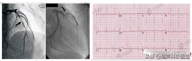 t波倒置9个真相图解,t波倒置判断口诀