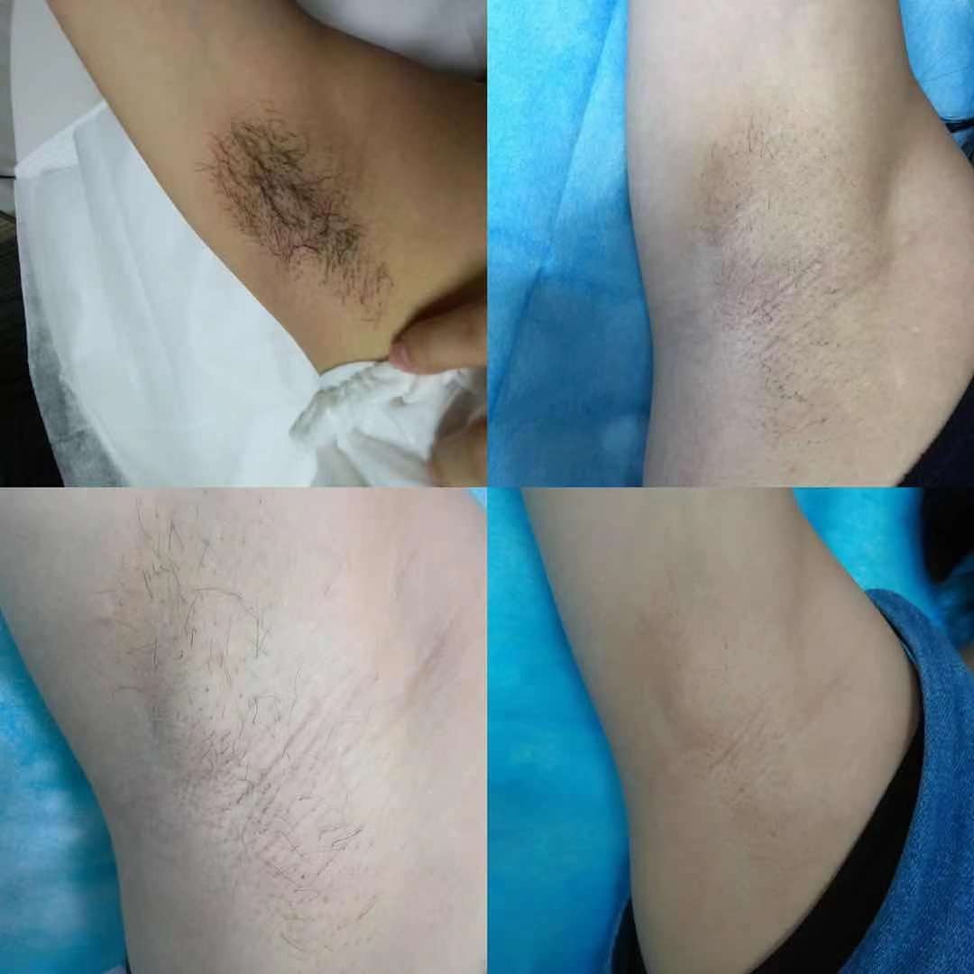 哪种毛适合激光脱毛,最近的激光脱毛