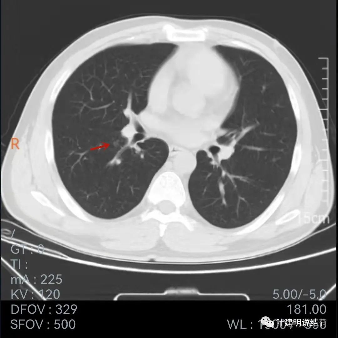 问诊分析:存在了4年的实性结节会不会是肺癌?
