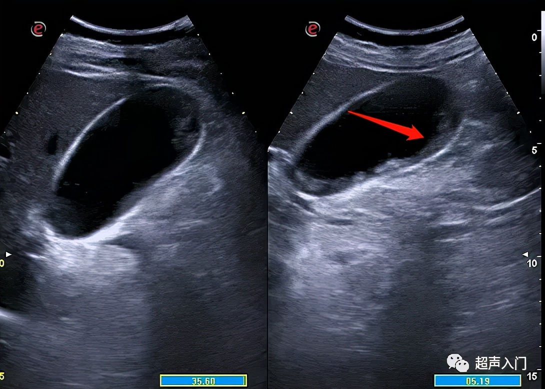 急性胆囊炎超声表现入门教学视频,急性胆囊炎超声诊断怎么写