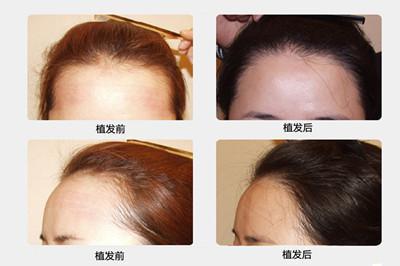 植发后的水肿要多久才能消失,植发头皮上打麻药水肿怎么消肿