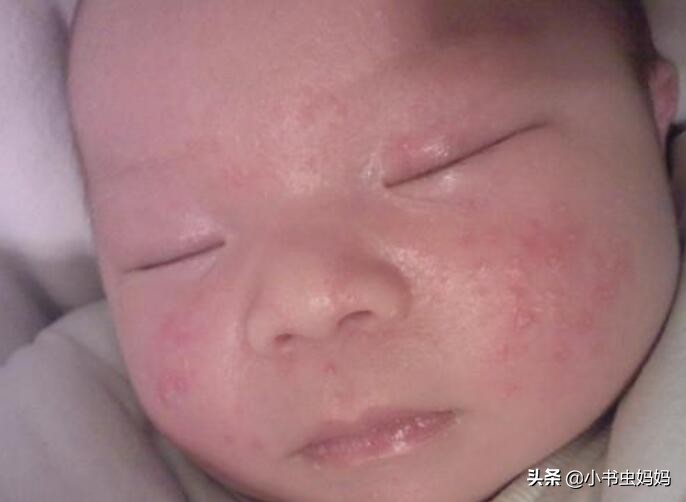 三个月宝宝喝奶粉为什么反复奶癣,一岁宝宝奶癣怎么根治