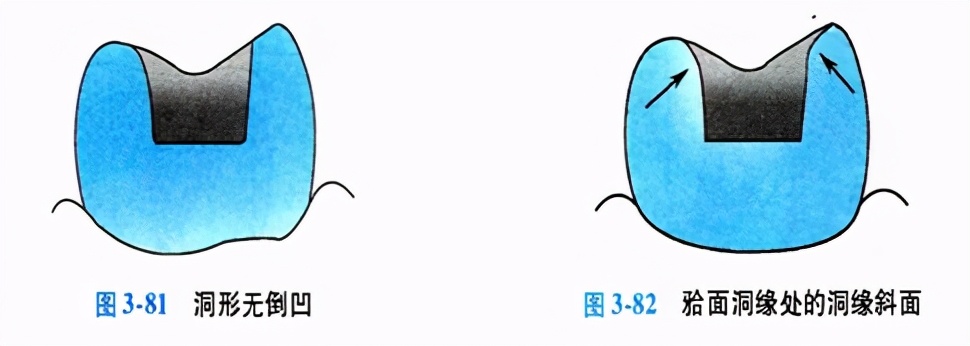 牙科嵌体的处理,牙科医生讲义