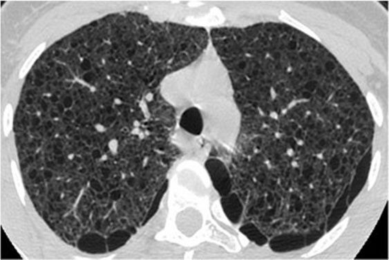 间质性肺疾病看病经验分享,分享肺腺癌临床实验的例子