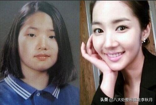 双眼皮刚做完很好看越恢复越难看,双眼皮做完感觉自己睁眼睛不自然