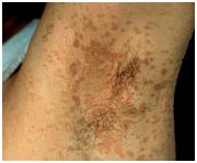 夏日如何远离体癣缠身你了解吗,长期皮癣体癣特别痒教你简单1招