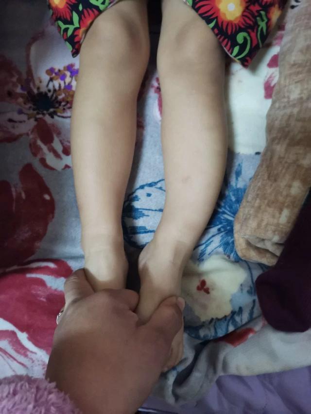 绑腿带对20岁矫正o型腿有用吗,1岁宝宝o型腿晚上睡觉绑腿有用吗