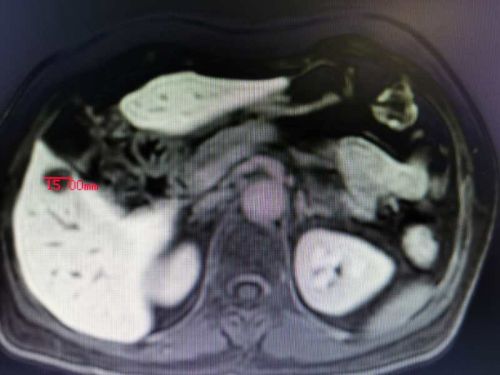 结直肠癌肝转移还能手术吗,结直肠癌肝转移的介入治疗