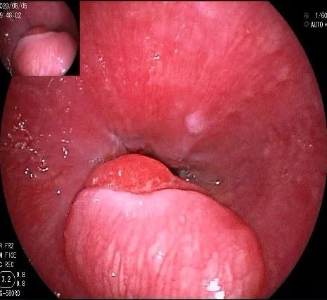 贲门隆起性病变影像,贲门溃疡隆起性病变