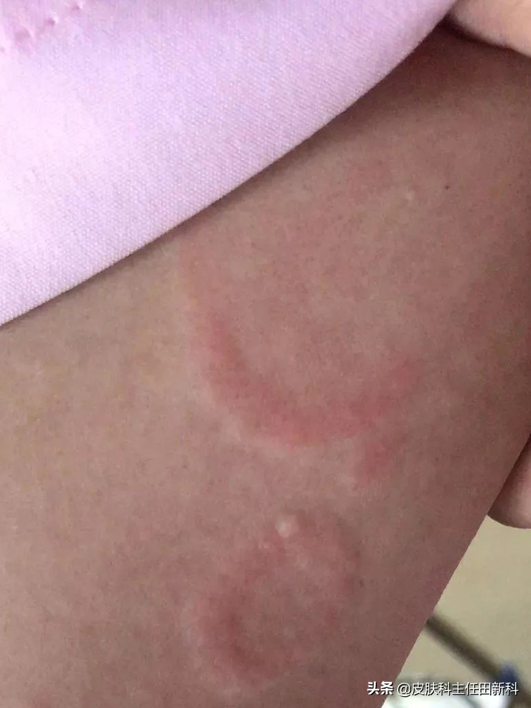 脸上痘印变成癣了怎么回事,痘印长癣