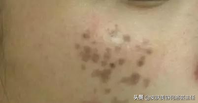 脸上有黑色素沉着斑怎能治好,脸上有色斑的护肤教程