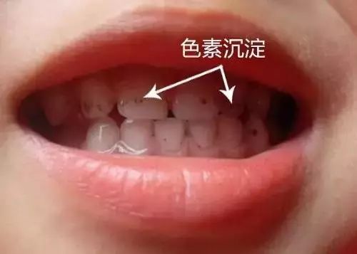 孩子嘴里味道很怪,儿童嘴里有消化不良的味道