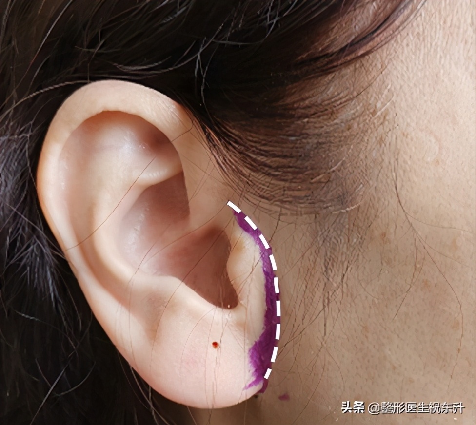 拉皮手术后的疤痕处怎么修复,腹部拉皮手术能去除剖腹产的疤吗