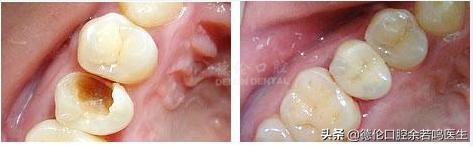 里面的牙如何修复,现在哪里有修复牙齿的
