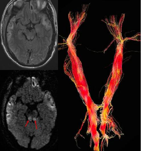 磁共振dti融合成像,磁共振dti成像作用