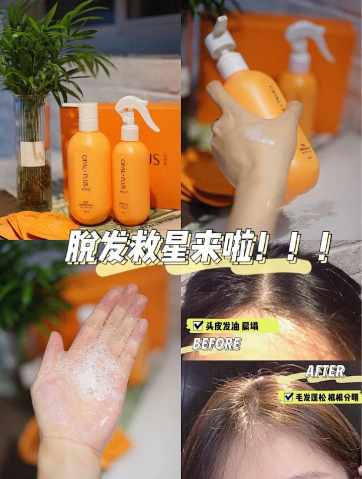 头发油掉发脱发很严重怎么办,掉发脱发严重有什么好办法改善吗