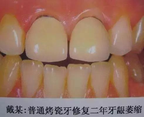 如何挑选烤瓷牙材料,怎样选择适合你的烤瓷牙