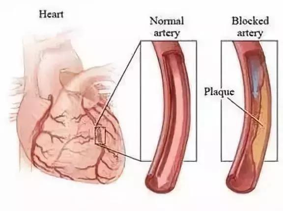 心肌梗塞中药调理好还是西药好,心肌梗塞喝汤药管用吗