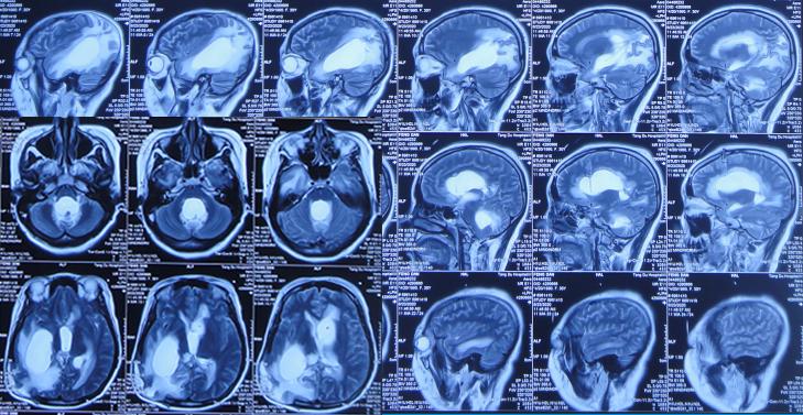 脑室有粘连脑积水有什么办法,脑动脉畸形手术后出现急性脑积水