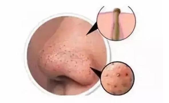 娇韵诗祛黑头和科颜氏祛黑头,怎么去黑头小窍门8招简单有效