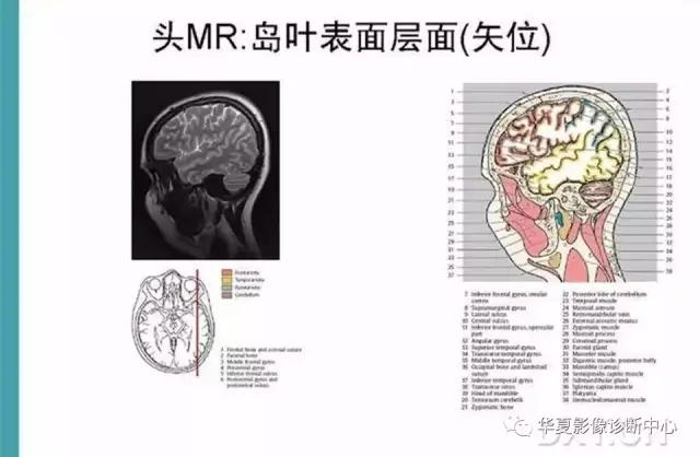 电子版头颅ct与mri断层解剖,头颅mri血管解剖与分段详解