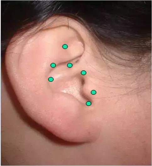 针灸减肥视频大全,面部减肥针灸视频