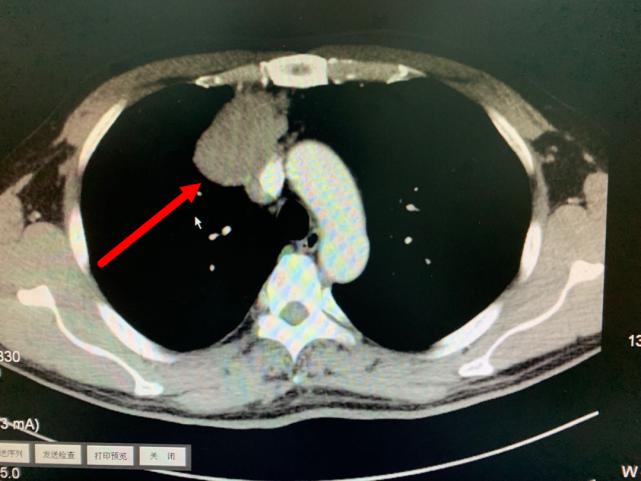 胸腔有拳头那么大的瘤严重吗,胸腔长了个八公分囊性肿瘤