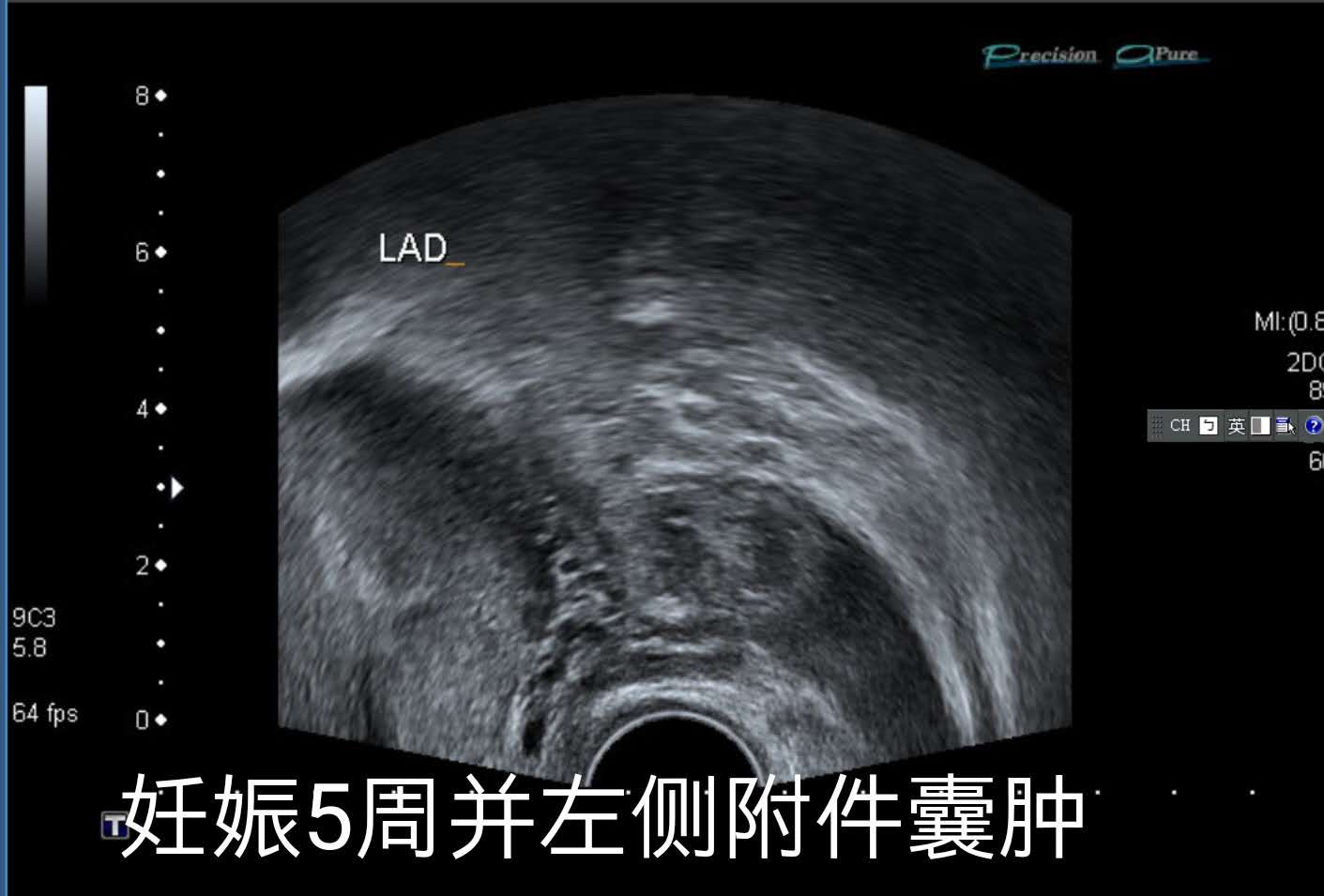 双胞胎，一个在宫内，一个躲宫外。孕妈生命垂危，医生妙手回春！