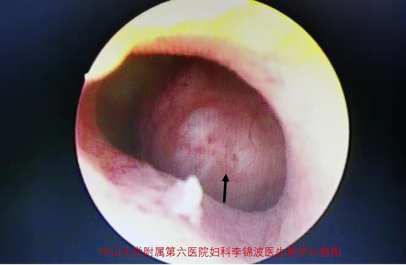 子宫肌瘤是不是必须做手术,子宫肌瘤做微创好还是手术开刀好