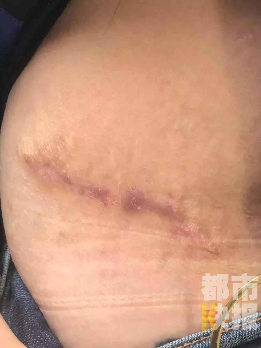 西安女子除妊娠纹,西安女子医院去妊娠纹